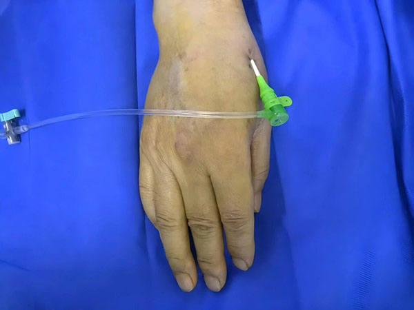 Правосторонний дистальный лучевой доступ